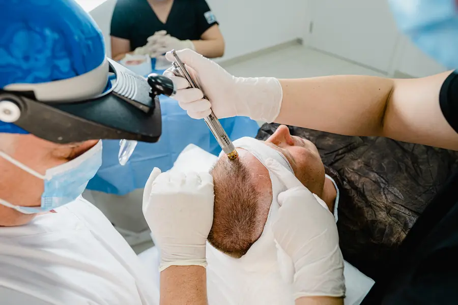 DHI implanter kalemle greft yerleştirme aşaması